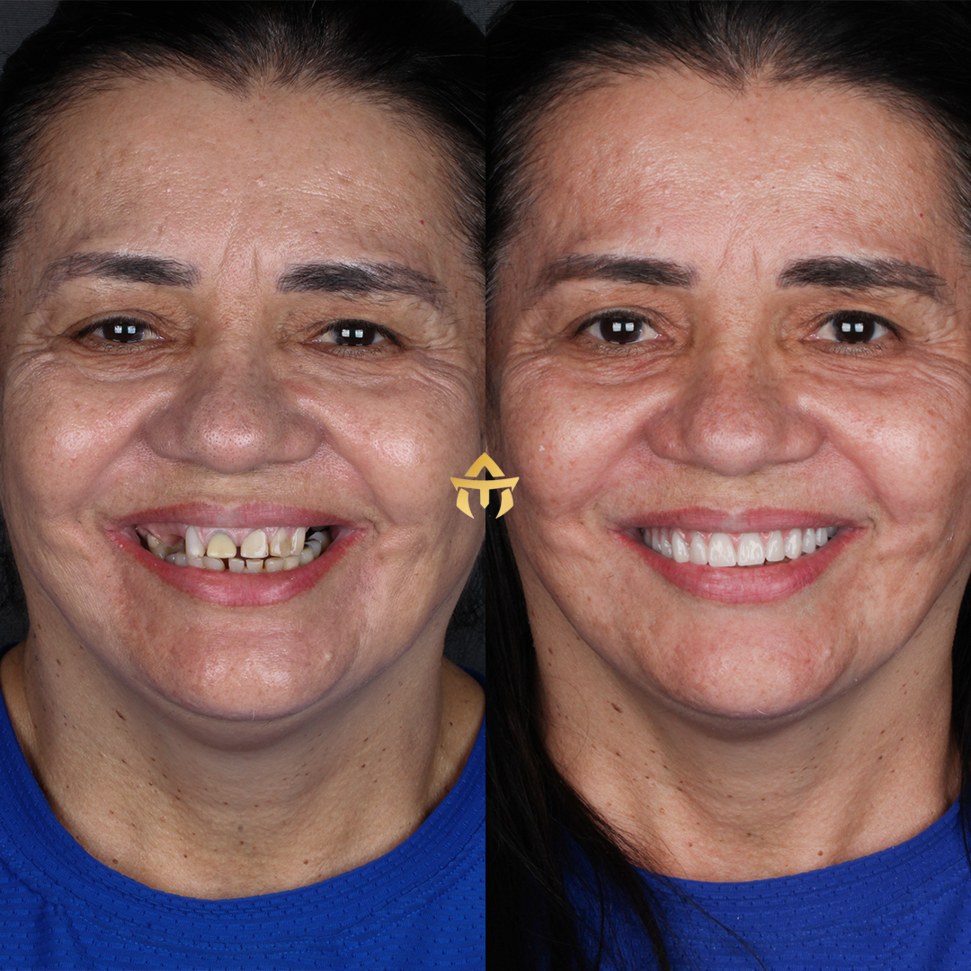 antes e depois 2