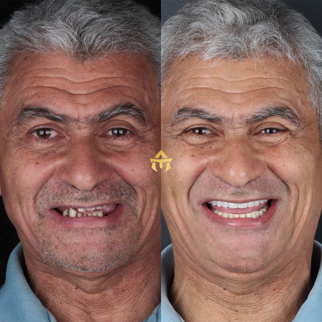 antes e depois 3