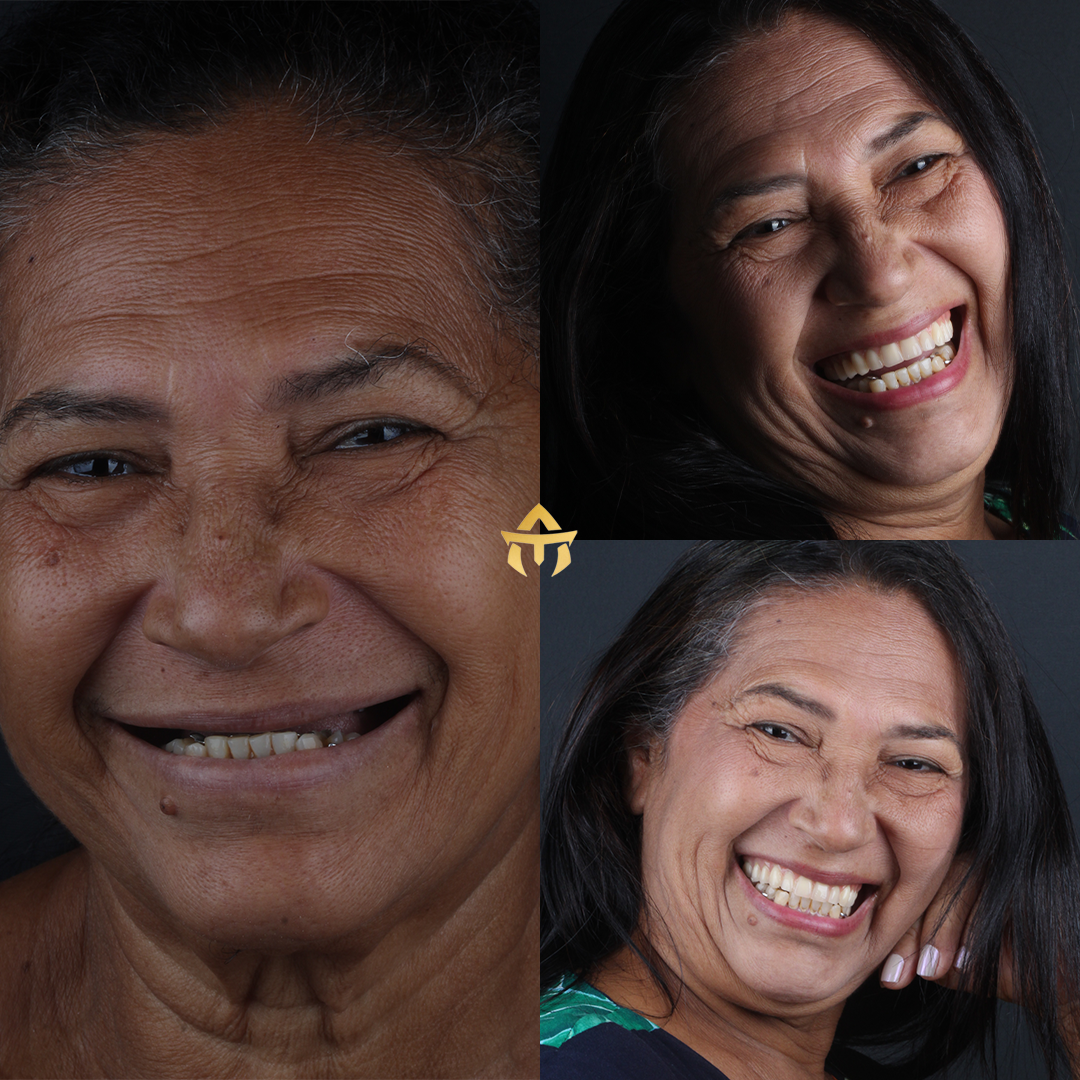 antes e depois 4